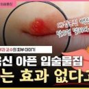 입술 물집 생기는 이유 구순포진 이미지