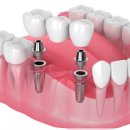 은평장수플란트치과의원 | 은평구치과 고민된다면