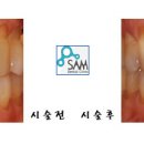 Re:치아미백이랑 신경치료한 앞니 문의! 이미지