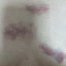 에버성형외과의원 | <내돈내산> 가슴켈로이드후기