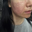 힐러PC | 강남피부과 리쥬란힐러 2cc 통증 2주 효과 후기