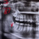 다니엘의원 | 집콕하며 쓰는 사랑니발치후기+Okinawa 여행기