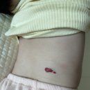 마포공덕에스앤유피부과의원 | 마포공덕 에스앤유피부과 5개월 아기 혈관종 진료 후기