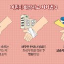 화상 응급처치 연고와 화상 물집 이미지