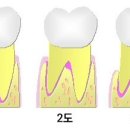 치근 이개부 병변[Furcation involvement] 이미지