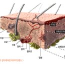 통합보험: 화상 진단비 특약에서 심재성 2도 화상이란? 이미지