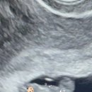 임신 5~7주차 극초기 임신 증상|진주미래여성병원 심장 소리 초음파 후기|모성결과 확인