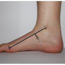 Pes Planus(Forefoot valgus deformity) Test : Feiss'line 3등분선 이미지