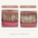 현대홈타운 상가 | 장안동 현대홈타운1차상가 애플치과의원 앞니 라미네이트 후기
