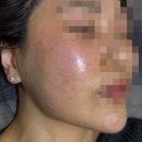 평택서울제일병원 | 평택 패인 여드름흉터 피부과 내돈내산 후기