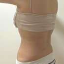 때빼멍 | 강남역러브핸들 복부 무한람스 후기 비용, 멍 그리고 붓기 찐 3주차 효과 -11cm