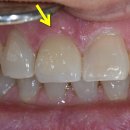 길동치과의원 | 앞니 깨짐 앞니크라운 치료 길동역치과