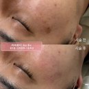 일광화장품 | 부산 서면 기미 잡티 흑자제거 비용 (+2주 전후 후기)