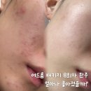 브이빔퍼펙타 아큐토닝 8회 패키지 끝 | 좁쌀여드름 실핏줄 효과는?