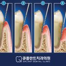 큐플란트치과의원 | 평촌치과 큐플란트치과에서 잇몸치료를 적극적으로 권유 드리는 이유