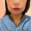 성남 얼굴윤곽주사 맞고 브이라인찾은 후기