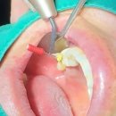 엔도코리아 | 엔도위즈 1주일 데모했는데 아쉬워서 어쩌죠? (보존과 원장님 생생후기,출처 포함)