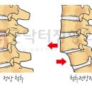 척추 45번에 흔한 척추분리증 관리하기 나름이다 이미지