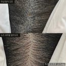 일산두피문신 SMP 가격 300만원 주고 망한후기