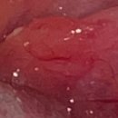 자성한의원 | 생리 중 비염 편도선 해결책을 찾다｜몬테롤정 류코트리엔 조절제