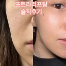 더블브이커피 | 포트라리프팅 브이라인 전후사진 대박인 홍대피부과 솔직후기