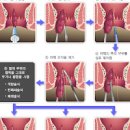 치질 증상 치료법 이미지