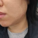 센텀시티역 | 부산 센텀시티역 피부과 PN리빌더T 성인여드름 관리 후기
