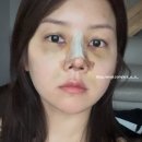 아라약국 | 코젤코 수술 D+6 솔직 후기｜멍·붓기·호박즙·멍크림까지 총정리