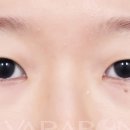 바라본성형외과의원 | 쌍수뒷트임 수술 후 1개월 경과 사진과 후기