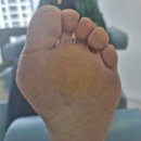풋스올경기 | [티눈 관리 후기] 풋스올 수원점 오래된 티눈, 뒷꿈치 굳은살 관리 사례