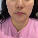 꼼신 | 송도 리프테라 볼살 리프팅 슬림해지는 인천 성형외과 시술 후기