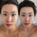 정안 | 강남에스테틱 바른얼굴 정안 비대칭 교정 솔직후기