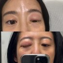 막달 임산부 결막염 증상, 안약, 완치