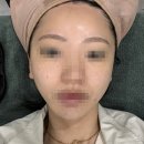 브이패스 | 인천 송도 클리닉] 인천 송도 잡티제거 피코슈어, 줌패스, 엑셀브이 레이저 내돈내산 후기! 전후사진 있음.