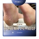 서창약국 | 엔피케어 인천서창점 인천발각질 관리 전 후 비교 찐 후기