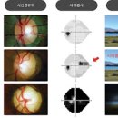 녹내장 초기 (원인) 이미지