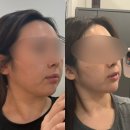 바른지성한방병원 | 강남역 피부과 온다리프팅 8만줄 솔직 후기 | 온다 리프팅 효과 통증 가격