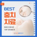 베스트원치과기공소 | 상남동치과 충치 치료, 원데이 인레이로 하루 만에 끝낼 수 있을까?