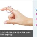 방아쇠수지 방아쇠 수지 증후군 원인 방아쇠수지증후군 주사 이미지