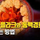 혈관 플라크 제거 3개월 프로젝트 이미지