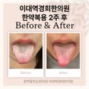 연아한의원 | 사행성탈모 이대역경한의원 맞춤한약 탕전일지, 체질개선 두피재생 치료후기, 연아약침 PDRN, 마포 신촌...