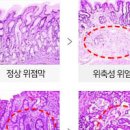 장상피화생 증상 및 치료 전후 실천해야 할 사항 이미지