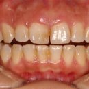 치아미백에 대한 궁금증 해결 (치아미백 전후 사진 및 과정) 이미지