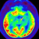 비정형 파킨슨 증후군[Atypical Parkinsonism]뇌신경정신질환 이미지