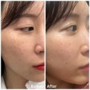 예솜의원 | 잠실새내피부과 추천 기미 잡티 색소 토닝 일주일차 후기 (feat 예솜의원)