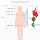 기쿠치병 기쿠치씨 병 원인 증상 림프절 종대 림프절 특징 기꾸찌병 기꾸치병 키꾸찌병 원인 증상 이미지