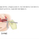 초기유산 화학적유산 창원파티마 소파술 과정 후기 소파술 후 임신 생리