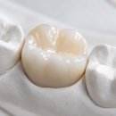 서울부부치과 | 퇴계동치과? 10년 문제없는 충치 보철 치료 TIP <의사 작성>