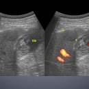 Gallbladder cancer(77/M) 이미지