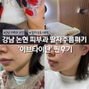 타이탄 짐 | 강남 논현 피부과 이브타이탄 팔자 주름 리프팅 후기